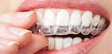 Unsichtbare Behandlung Iinvisalign